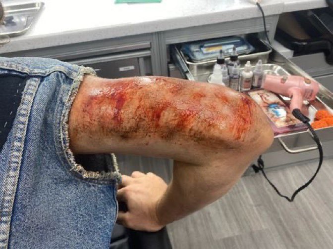 spcecdets's tweet photo. be fucking fr rn these were just his arm and back scars and he was sticking the landing off bed sheets into the upside down hours later 😭😭 ???? nuh uh lmaoooooo https://t.co/49XOCw7S5z