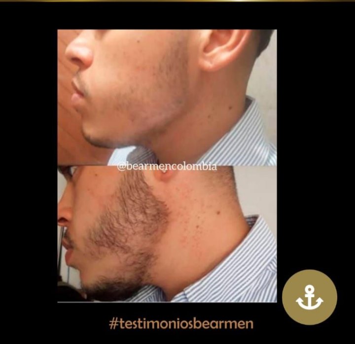 BearmenC's tweet photo. Avances con Bearmen 🐻
.
.
#biotonico #crecebarba #bearmencolombia #kitbearmen #tonicobarba #ososcolombia #minoxidilcolombia #minoxidilmedellin #osocolombiano #beargay #colombia #barbaroja #sexybeard #barbatonico #barbalarga #barbudo #barbastyle #quierobarba #biotina #shave https://t.co/DYQPPjmyTQ