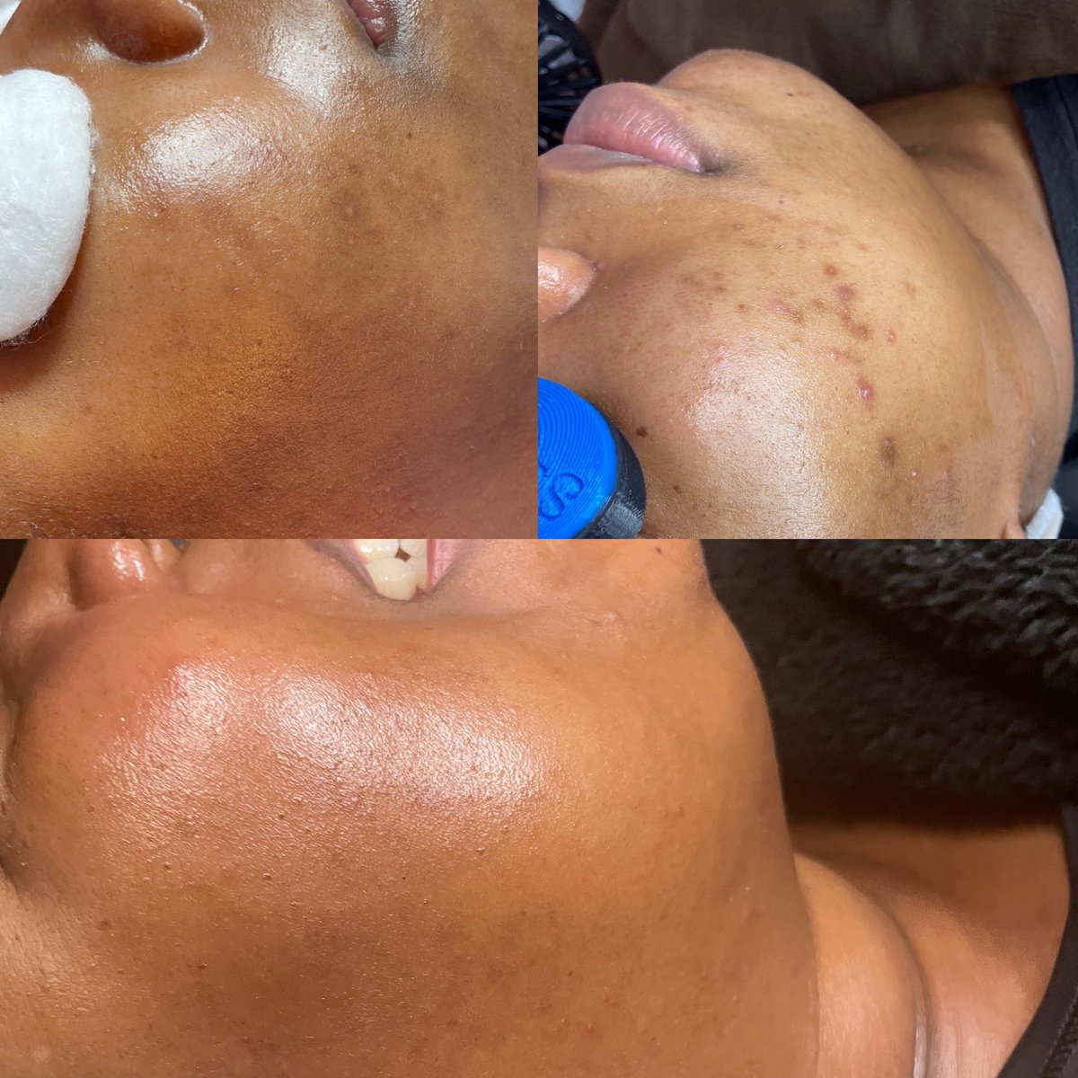 Hyperpigmentation is one of the biggest and hardest things to correct. What you eat, your environment and consistency is key. This beauty came to me consistently and we would discuss any recent breakouts and she would realize by herself why her skin broke out.