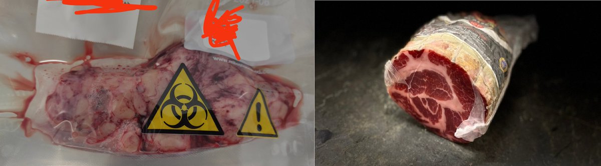 ManticaGu's tweet photo. #salame vs #prostate : find the differences. 300 cc adenoma.
#opensurgery #adenomectomy #fun <3 open #UroSoMe
@DPanarelloMD https://t.co/jkLehLDaOf