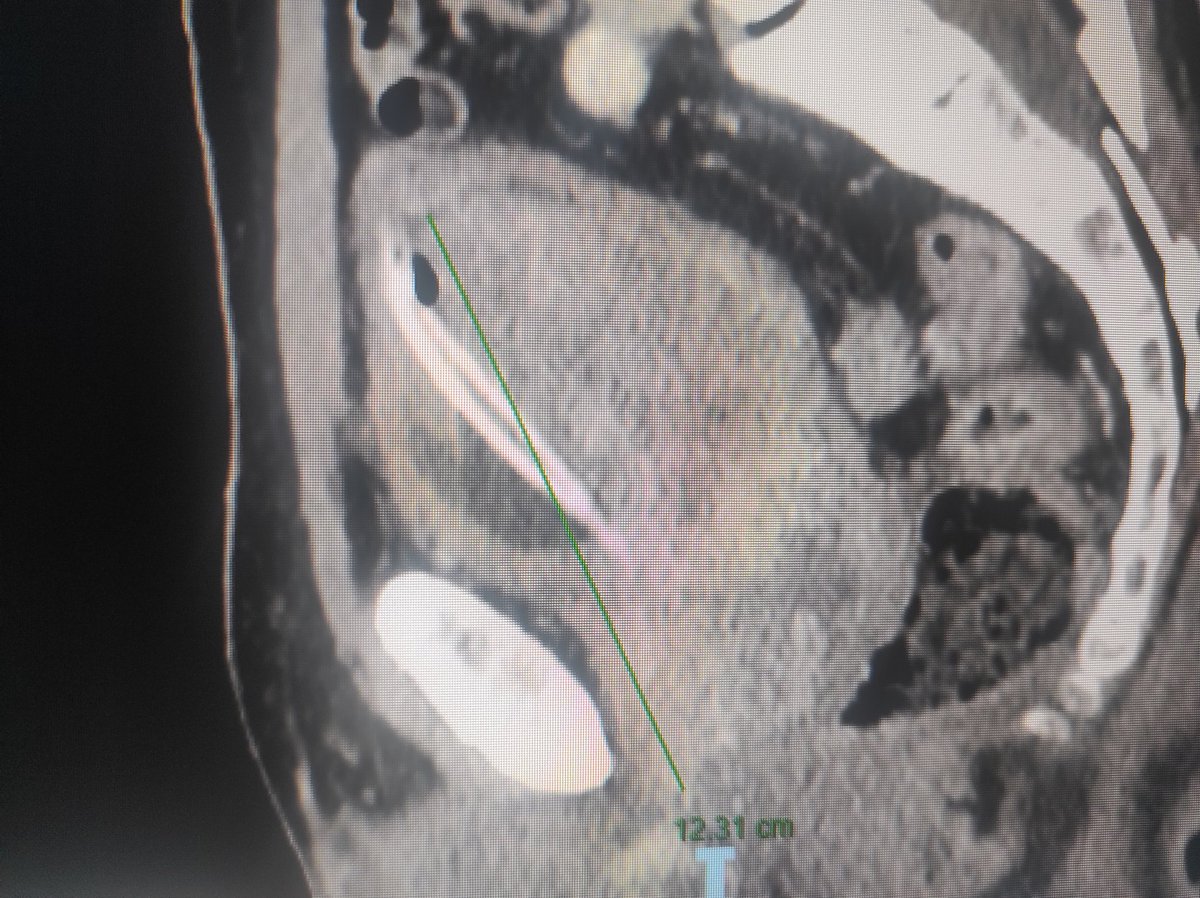 ManticaGu's tweet photo. #salame vs #prostate : find the differences. 300 cc adenoma.
#opensurgery #adenomectomy #fun <3 open #UroSoMe
@DPanarelloMD https://t.co/jkLehLDaOf