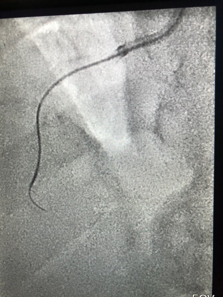 BSCCardiology's tweet photo. Great work by Dr. David Zagha of JSUMC New Jersey who utilized HORNET 14 to cross this calcified RCA #CTO. Check out the before and after images of this OPTICROSS HD #IVUS-guided PCI to optimize deployment of a SYNERGY XD 3.50x48mm and a proximal 4.00x24mm SYNERGY MEGATRON. https://t.co/4gJyfYJ290