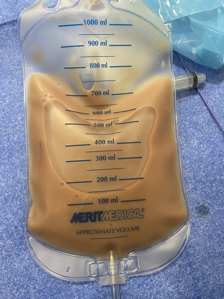 MuhammadAjmalMD's tweet photo. Fluid removed by pericardiocentesis! https://t.co/gbwLs9yCNr