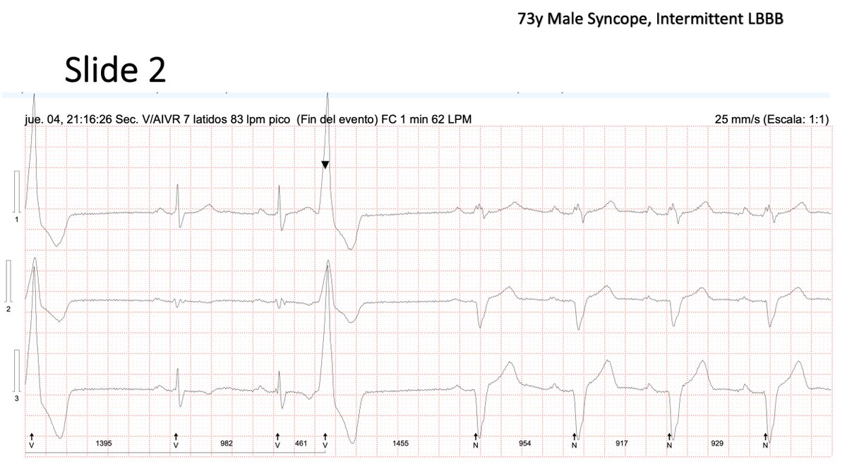 FellowEP's tweet photo. Hi, #Eppeps! No more fancy maps but a really interesting Holter. 73y Intermittent LBBB + syncope: Concealed conduction, Peel back, Dual nodal pathways, phase4 LBBB block??. Can one of the ECG experts help me understand this one? @narrowQRS @adribaran @SergioPinski @EPeeps_Bot https://t.co/fcdGrHM7wU