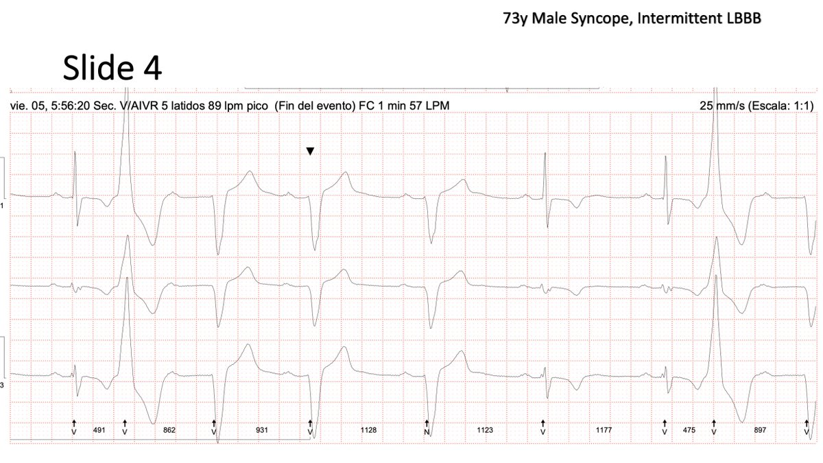 FellowEP's tweet photo. Hi, #Eppeps! No more fancy maps but a really interesting Holter. 73y Intermittent LBBB + syncope: Concealed conduction, Peel back, Dual nodal pathways, phase4 LBBB block??. Can one of the ECG experts help me understand this one? @narrowQRS @adribaran @SergioPinski @EPeeps_Bot https://t.co/fcdGrHM7wU