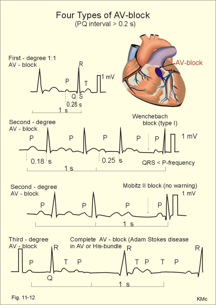 Quick review of AV heart blocks!