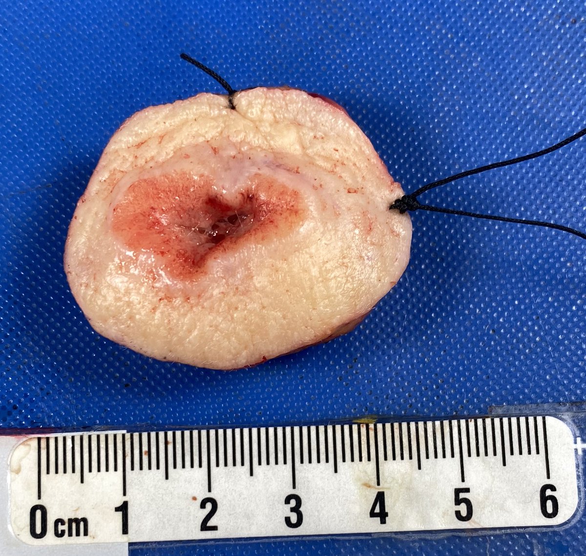 TopfHNS's tweet photo. Using our 3D scanning and specimen mapping protocol to help guide cancer re-resections after pathologists found a close margin. #CADmargin #HeadandNeckCancer @_KavitaPrasad @Alexis_B_Miller https://t.co/JO4Xx4bulT