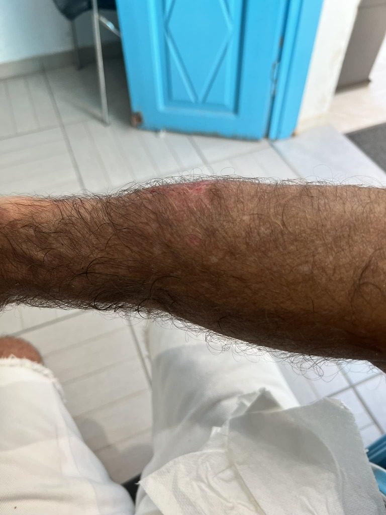 Scruzzer's tweet photo. I have lots of Greece pics coming soon. In the meantime, just know that walking in Greece can be hazardous. Nothing is flat! This isn’t my elbow. I fell hard and thought I broke my forearm. Rushed to a clinic and found the lump to be a hematoma. I had a … https://t.co/AKTIE3MtDp https://t.co/vjOejlhqCK