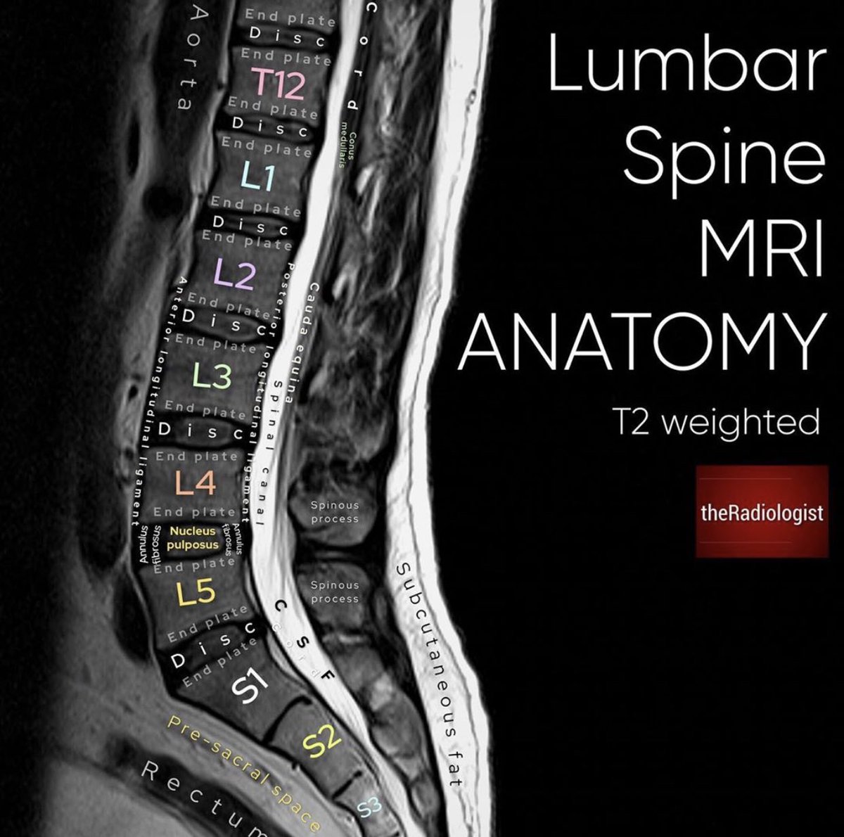 Help with your Lumbar spine MRI anatomy knowledge from <a href="/radiologistpage/">theRadiologist</a>