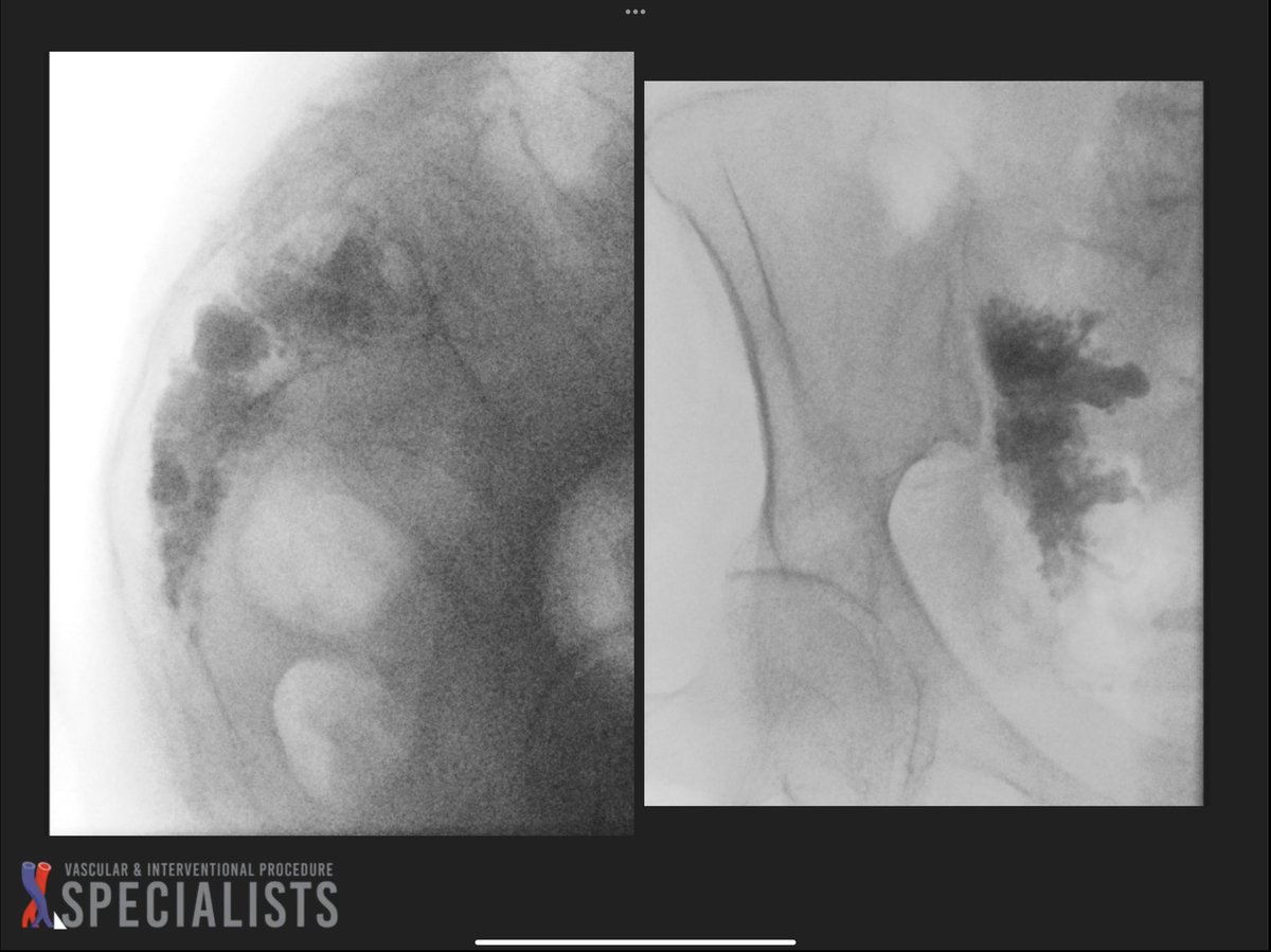 darthglader's tweet photo. T12 #kyphoplasty and left #sacroplasty using the curved introducer technique, with beautiful #FillGoals in the left sacrum - 14 mL of cement injected. @dougbeall @AlanAlperMD https://t.co/9TkGIvAasV