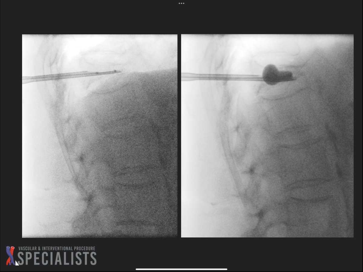 darthglader's tweet photo. T12 #kyphoplasty and left #sacroplasty using the curved introducer technique, with beautiful #FillGoals in the left sacrum - 14 mL of cement injected. @dougbeall @AlanAlperMD https://t.co/9TkGIvAasV
