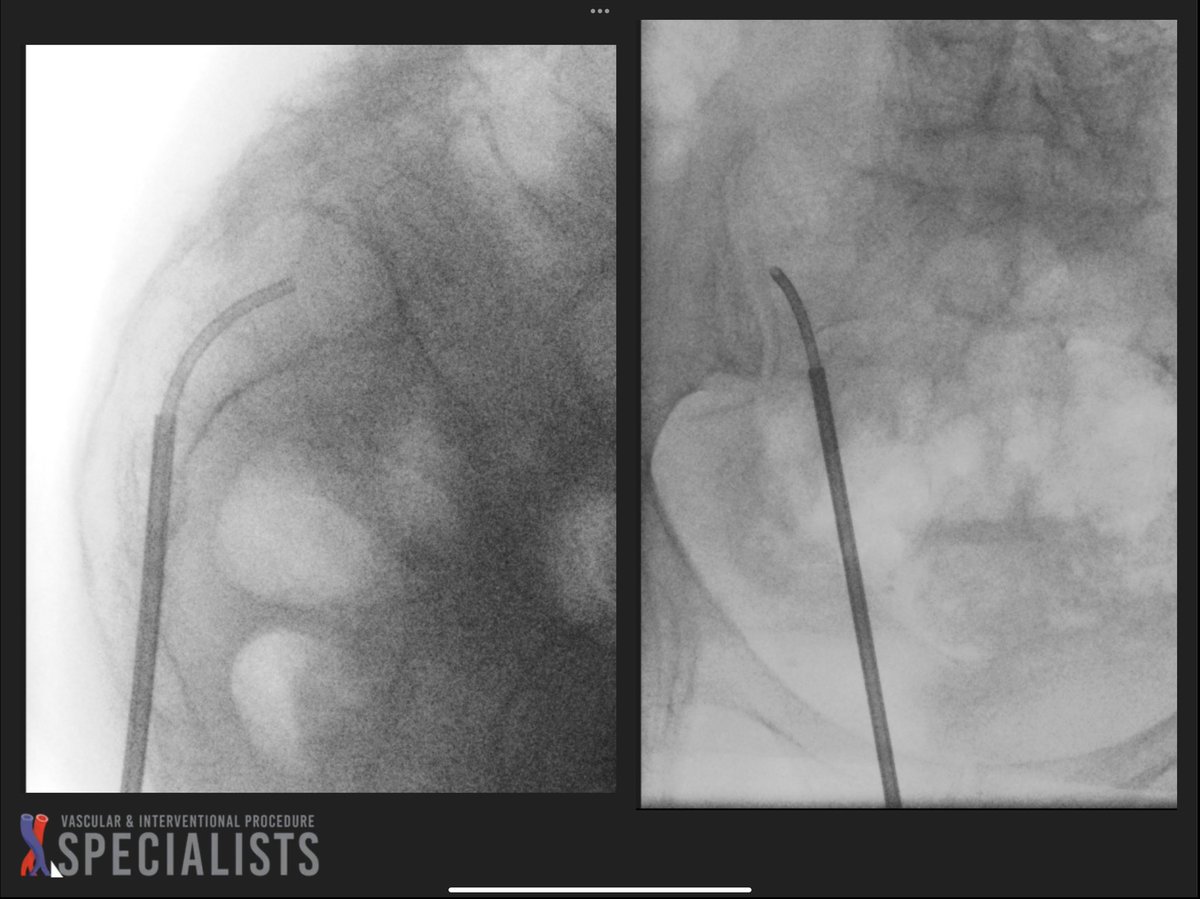 darthglader's tweet photo. T12 #kyphoplasty and left #sacroplasty using the curved introducer technique, with beautiful #FillGoals in the left sacrum - 14 mL of cement injected. @dougbeall @AlanAlperMD https://t.co/9TkGIvAasV