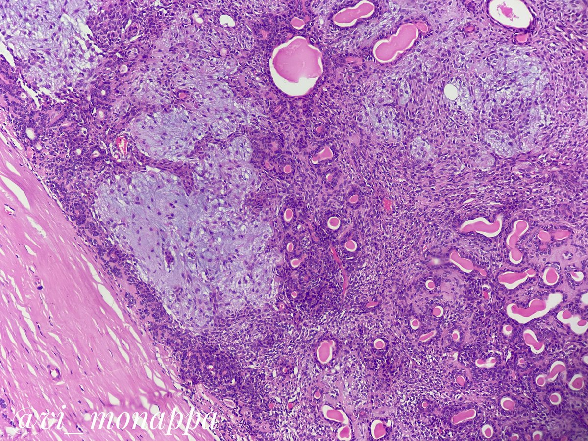 vi_monappa's tweet photo. #pathclassic #pathtwitter #pathboards #pathresident 
One pic spotter #pathspotters 
The molecular marker for this tumor is ______. https://t.co/14gIrjxcoN