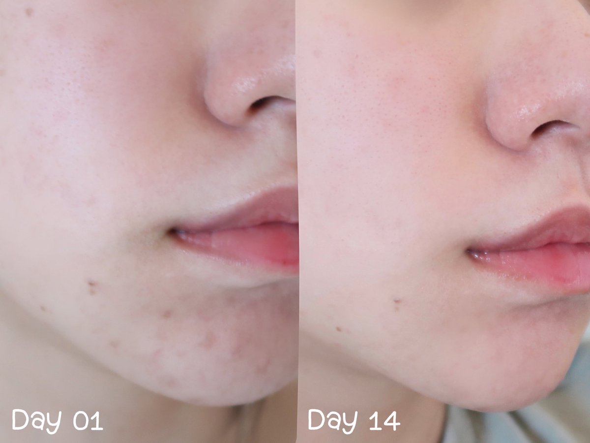 FKYz_'s tweet photo. ไปสอย 2 ตัวนี้ของยูเซอ���ินมา ดีมากกกก A.I. Matt Fluid ครีมลดสิว กับ Anti acne mark เซรั่มลดรอยสิว สิวชอบบุกตรงคางช่วงกำลังจะมีปจด รอยสิวก็เยอะมาก ตั้งแต่ทา 2 ตัวนี้คือสิวอักเสบยุบไว สิวอุดตันลดลง ไม่ค่อยขึ้นใหม่แล้ว รอยสิวก็จางลงมากๆๆ 🥹 #ใช้เองรีวิวเอง https://t.co/vrIUaqY2Um