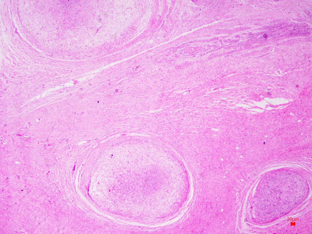 NewjobiRakesh's tweet photo. Spinal mass, young male #pathology #pathresidents #pathtwitter #pathboard #neuropath #pathologists https://t.co/vq7UBQ5uyA