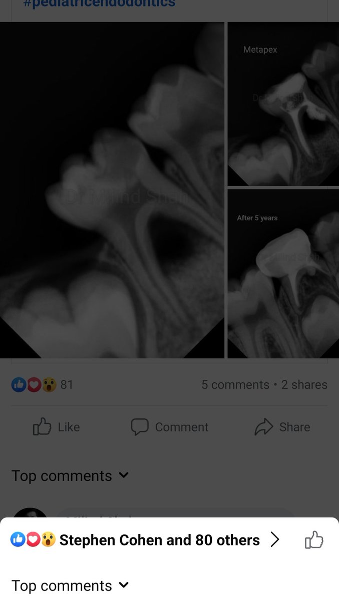 Child_Dentist's tweet photo. Appreciated by the legend of Endodontics for 2nd time.
Proud moment.
#dentistry #pediatricdentistry #OdontoTwitter #pediatricendodontics #odontopediatrica #dentalcare #pulpectomy https://t.co/wnTb6zabzh