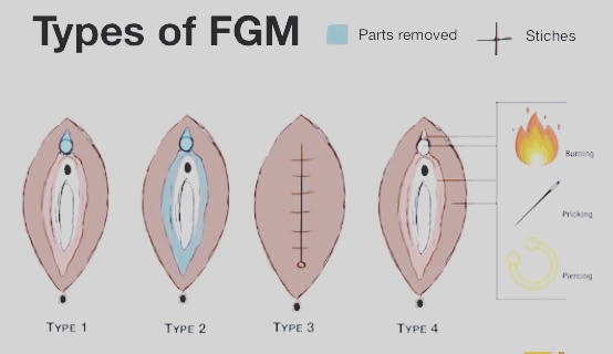FGM Type II – Excision
Partial or total removal of the clitoris and the inner labia, with or without excision of the outer labia (the labia are the ‘lips’ that surround the vagina).
#StopFGM
#RippleProject

@youthhubafrica
@UNFPANigeria
@GlobalSpotlight
@EUinNigeria 

@GMCEndFGM