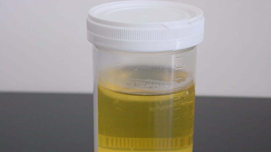 onthewardsorg's tweet photo. You are night cover on a surgical ward, and nursing staff ask you to see a patient Day 1 post-op with poor urine output. For the last 2 hours, 20 ml/h urine output. Can you chart a fluid bolus?
https://t.co/Yjt2Ynlyzg
#interns2022 #juniordocs #medicine https://t.co/LRME0nXzya
