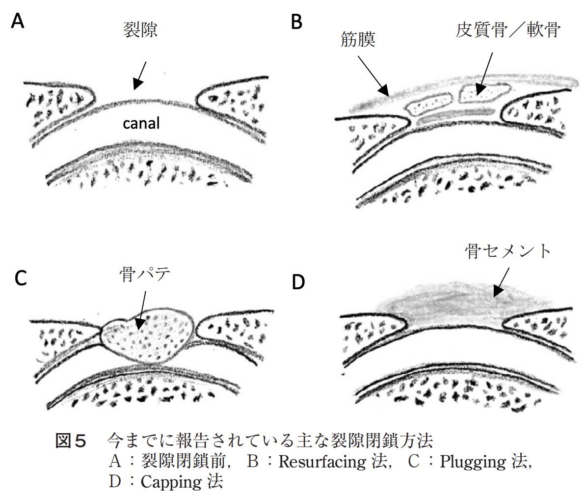 📜上半規管裂隙症候群 ・上半規管周囲の骨迷路に裂隙が生じ, 前庭/蝸牛症状を来す疾患 ・Tulio現象(巨大音による前庭反射 ...