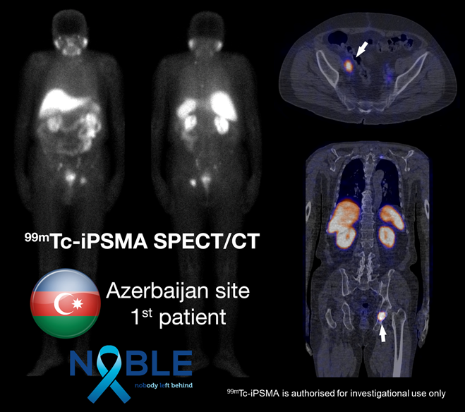 NobleRegistry's tweet photo. A 1st patient has been imaged in NOBLE Registry Azerbaijan!

PI Dr Novruzov, said: “It is wonderful to watch how a previously unattainable diagnostic modality (advanced PSMA imaging) has potential to be made available for everyone, leaving nobody behind!”

https://t.co/uC3rrzwoeK https://t.co/b4jLbSa0d4