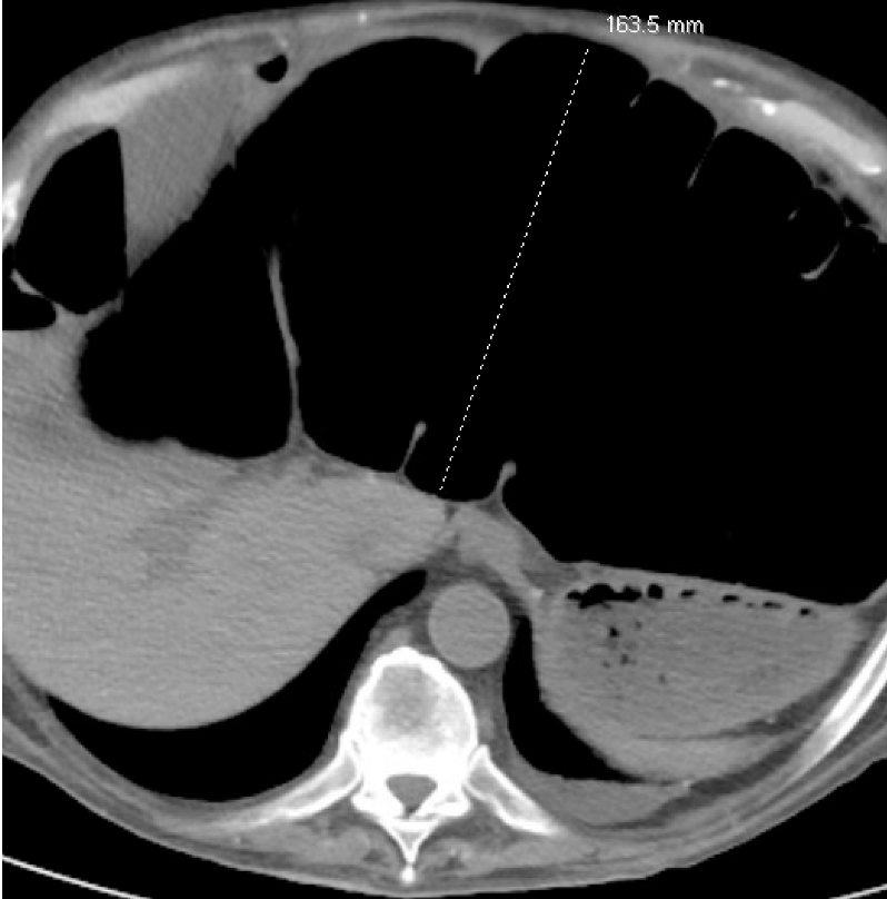 Traverse colon ileus with massive dilation of ~17 cm and patient mildy symptomatic 👉🤷 What is the largest diameter of colonic dilation one has encountered in their careers? #MedEd #gitwitter #gigang #medtwitter #SoMe4Endoscopy #SoMe4Twitter #MedTwitter