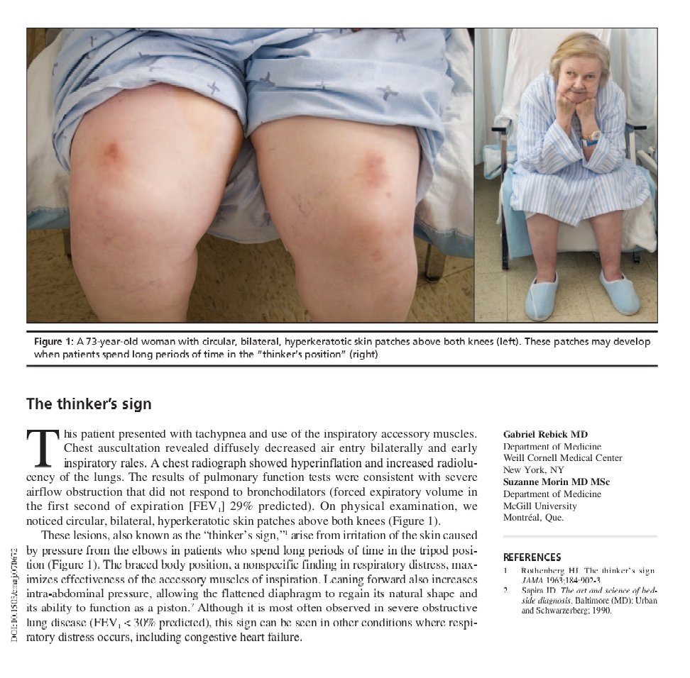 What do you "Think" these are..

circular, bilateral, hyperkeratotic skin patches above both knees👇...