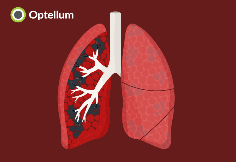 Dr Michael Gregory Lester MD and Dr Fabien Maldonado MD, of <a href="/VUMChealth/">Vanderbilt Health</a> have presented early findings in potential automated diagnosis and quantification of #emphysema using an <a href="/Optellum/">@Optellum</a> Deep Neural Network. 
optellum.com/2022/08/optell…