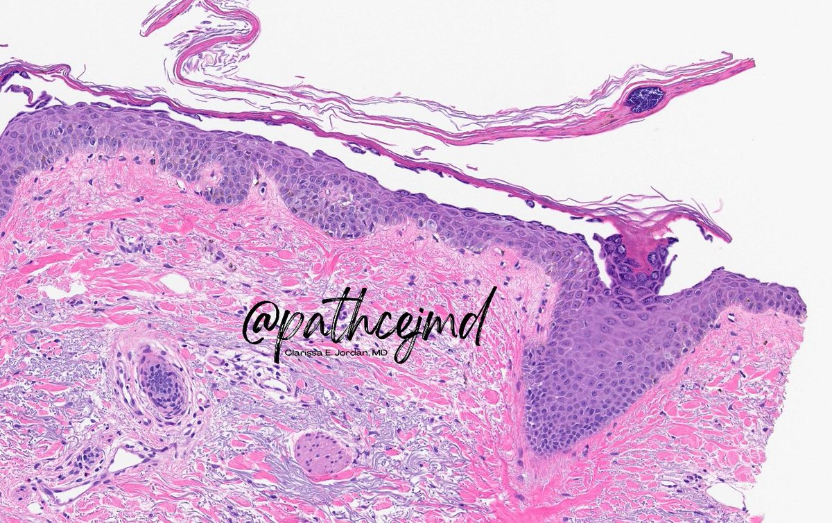 👋🏼 Quick #DermPath case-based #tweetorial (yes, I’m finally branching out from my beloved HemePath!) 🧵

What’s your diagnosis? (Poll ⬇️)

Always learning - welcome to any feedback! #PathTwitter