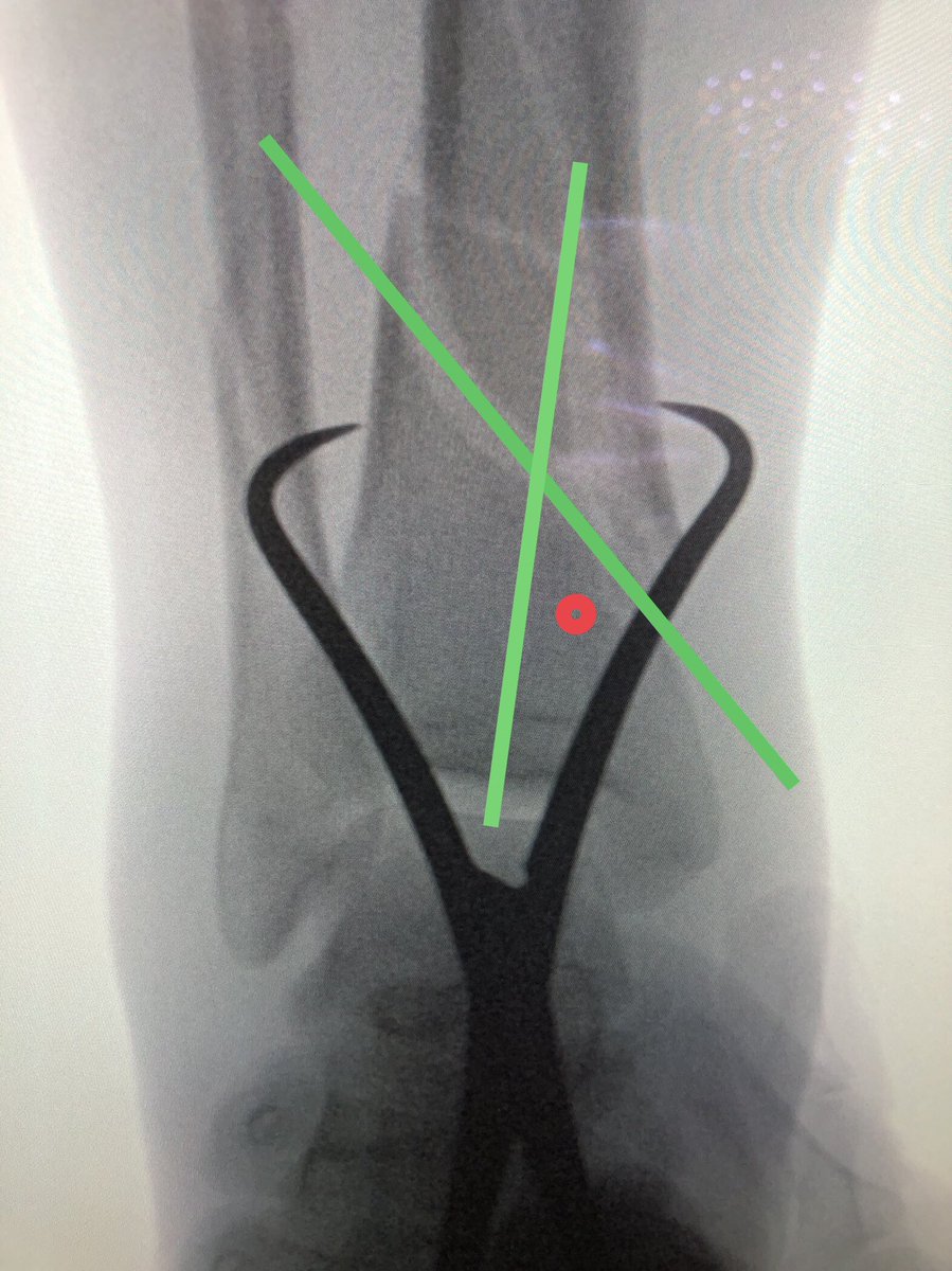 InvictaOrtho's tweet photo. [1/2] There are many ways of doing Poller screws. One simple technique is described here (https://t.co/HhJb88tKjg) in which you draw a line down anatomic axis of metaphyseal/short piece, then a line along fracture, and put the screw in the acute angle. I find it works well. https://t.co/0v5S027UWW