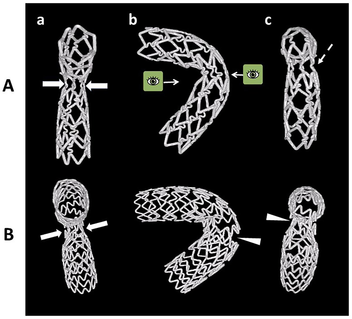 Our new paper concerning bifurcation angle has been just published in PLOS one. Impact of coronary bifurcation angle on the pathogenesis of atherosclerosis and clinical outcome of coronary bifurc… pubmed.ncbi.nlm.nih.gov/35976920/