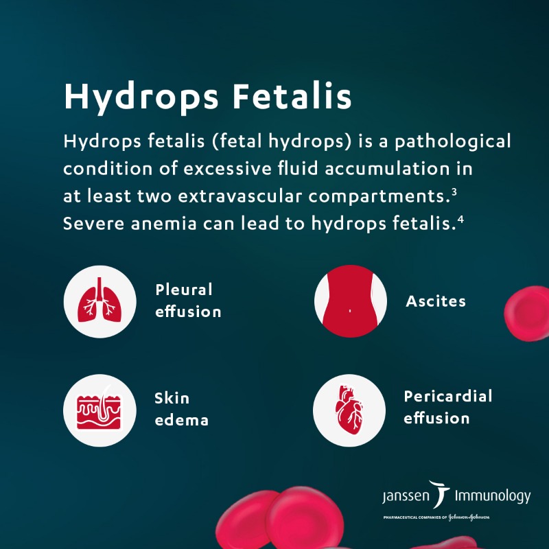 JNJInnovMed's tweet photo. Hemolytic disease of the fetus and newborn – or HDFN – is a rare maternal-fetal condition that occurs when a mother’s immune system attacks her unborn child’s blood cells. Slide to learn more about the impacts of this condition. #NFSAM