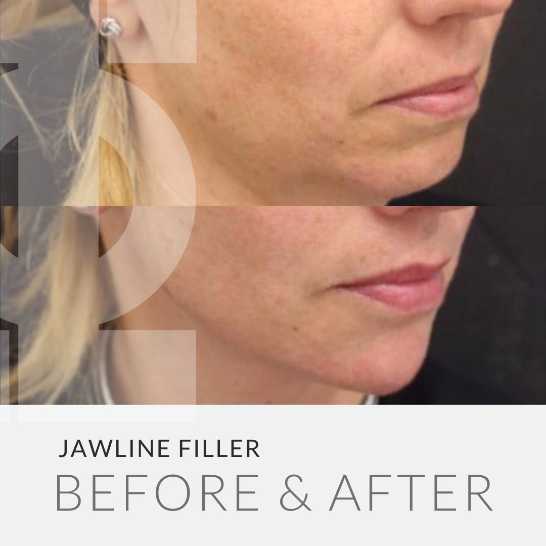 An incredible #transformationthursday by mixing the expertise of Dr Tapan Patel, with dermal filler. ⁣⁣
⁣⁣
Dermal filler was used to reduce the appearance of eye bags, define the cheekbones, elongate and project the chin, sharpen the jaw and to enhance the lips.⁣⁣