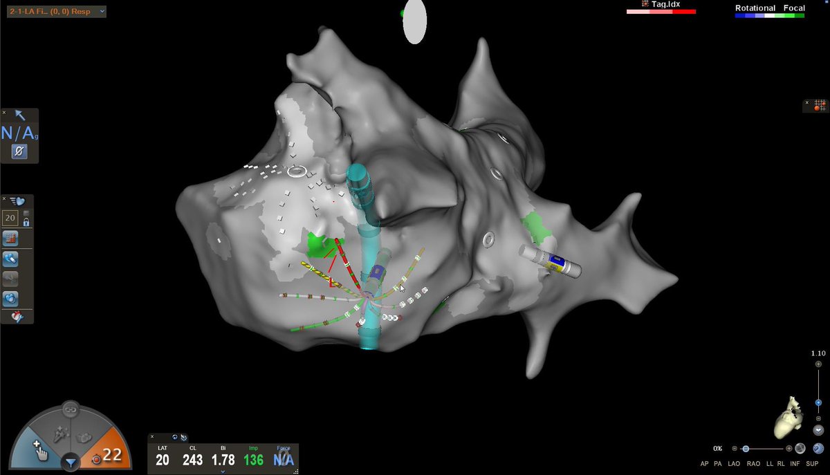 chris_sohns's tweet photo. First #Cartofinder procedure with 🐙Ray @HdzNrw only a few points cover the complete LA and fast mapping with 3-3-3-3 @Phiso_de @BiosenseWebster @nmarrouche @AGEP_DGK @melhamriti @ChristianHeeger #EPeeps #Octaray #AF https://t.co/0jjw8sE5Ch