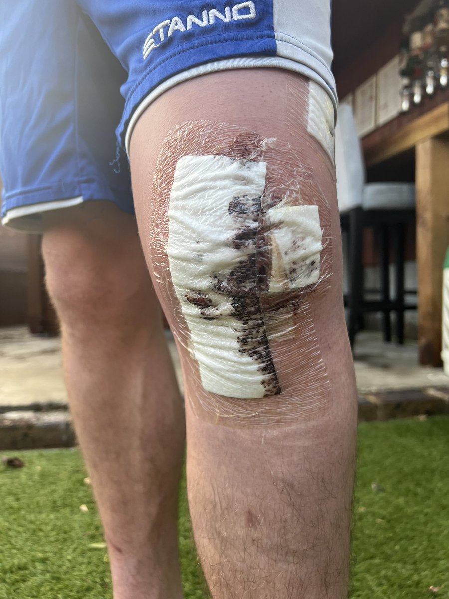 Will_manning22's tweet photo. Compression bandage off and showered (started to smell 😂) and now more mobile plenty of swelling but with the ice compression should start to come down. Worst part is the blood thinning 💉in to the stomach  #roadtorecovery #backstronger #smallsteps #ACL https://t.co/eH5msA8lan