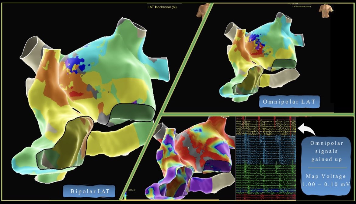 Without a doubt, #OT found the right spot. Just wanted to share these comparisons. Such a game changer for me. 

I really needed to gain up those signals to see them, but #EnsiteX sure saw them! System annotated amazingly.

[prop map in the thread]

<a href="/AbbottCardio/">Abbott Cardiovascular</a> @AjayPMD