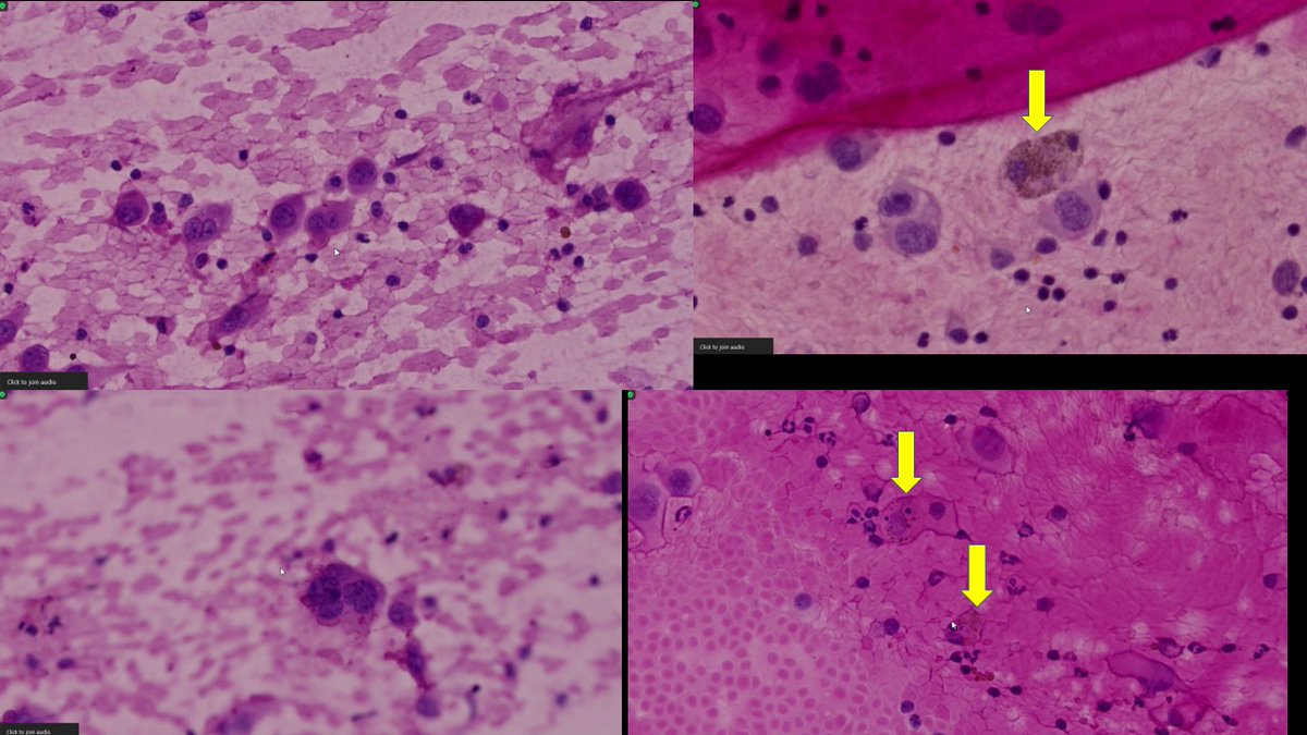 GaryKeeneyMD's tweet photo. Brain smear for trainees. Multiple brain lesions. Hx of skin tumor. How sure are you? Would you say “Consistent with, suggestive of, most consistent with” or just call it what it is? #justcallit @MayoClinicPath @MayoPathology https://t.co/kGeYdZer0t