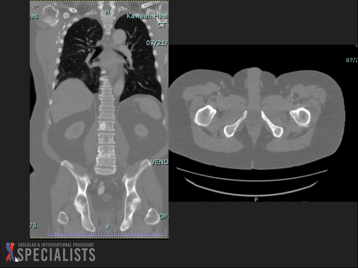 darthglader's tweet photo. As promised, the left inferior pubic ramus ablation using the #OsteoCool system by @Medtronic_Spine.
Put the needle all the way to the front, then ablated and drew back, ablated and drew back.
#NegativeStylePoints for the little curlicue of cement poking out. https://t.co/TvrUf3yAnQ