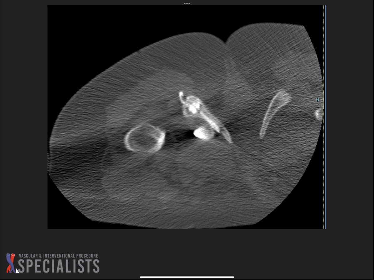 darthglader's tweet photo. As promised, the left inferior pubic ramus ablation using the #OsteoCool system by @Medtronic_Spine.
Put the needle all the way to the front, then ablated and drew back, ablated and drew back.
#NegativeStylePoints for the little curlicue of cement poking out. https://t.co/TvrUf3yAnQ
