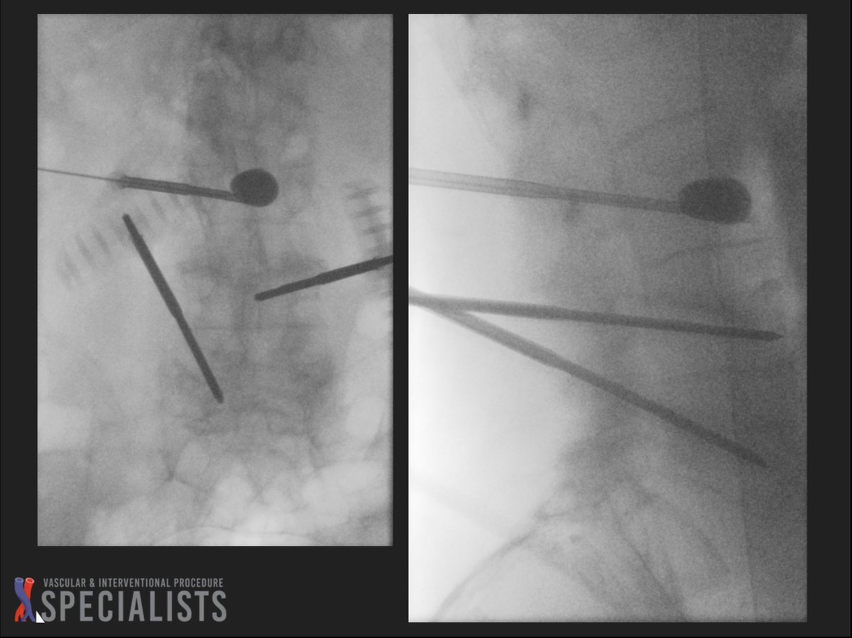 darthglader's tweet photo. 2 batches of cement: L3 and L4 with batch 1, then L5 with batch 2. #KyphonAssist to get a little more height restoration. 

L5 was tilted, making placement tough.

Wish more cement got into the L4 fracture. #FillGoals https://t.co/XF2IaQF3KQ
