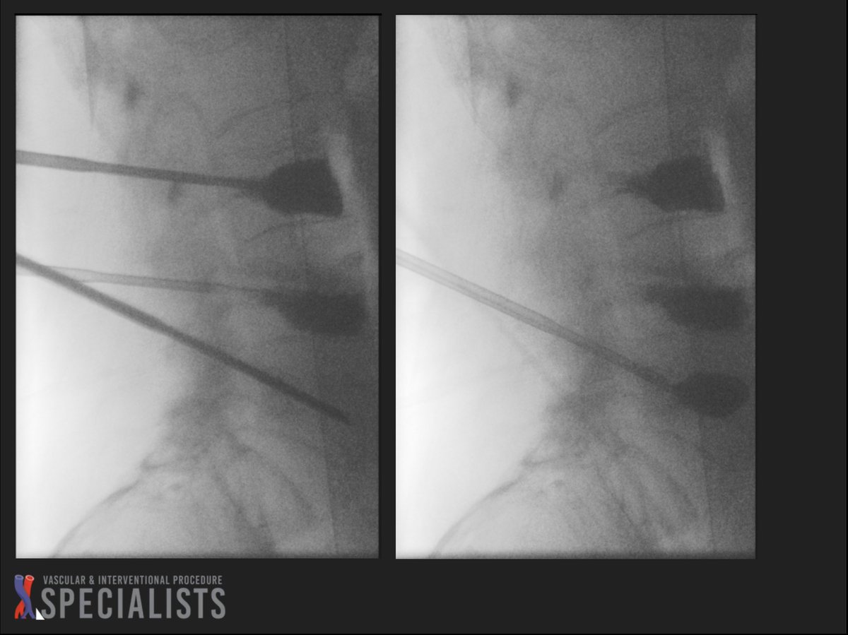darthglader's tweet photo. 2 batches of cement: L3 and L4 with batch 1, then L5 with batch 2. #KyphonAssist to get a little more height restoration. 

L5 was tilted, making placement tough.

Wish more cement got into the L4 fracture. #FillGoals https://t.co/XF2IaQF3KQ