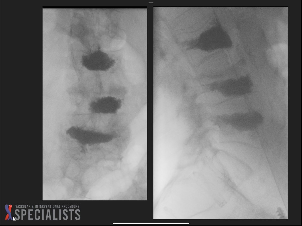 darthglader's tweet photo. 2 batches of cement: L3 and L4 with batch 1, then L5 with batch 2. #KyphonAssist to get a little more height restoration. 

L5 was tilted, making placement tough.

Wish more cement got into the L4 fracture. #FillGoals https://t.co/XF2IaQF3KQ