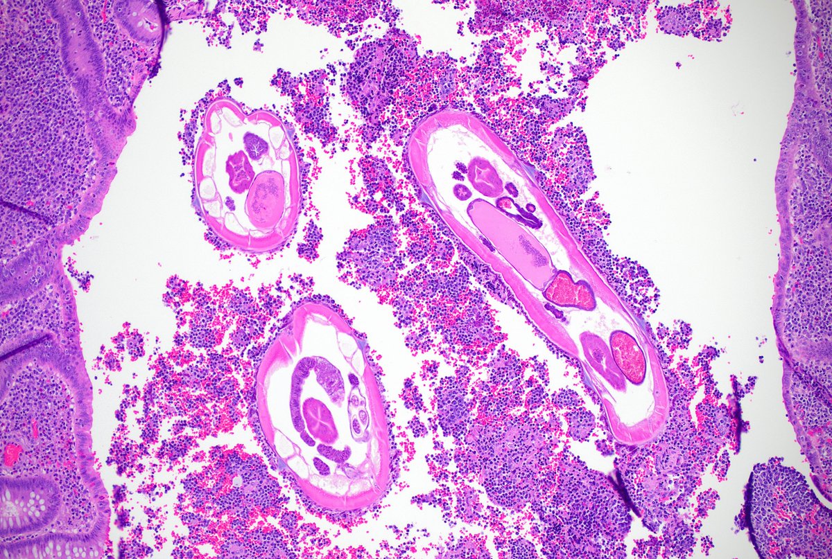 SunyUpstate's tweet photo. 10 yo boy with right lower quadrant pain. Can you make the diagnosis from this one image? #PathTwitter #GIpath @GirlAtTheScope https://t.co/93yg510QwZ
