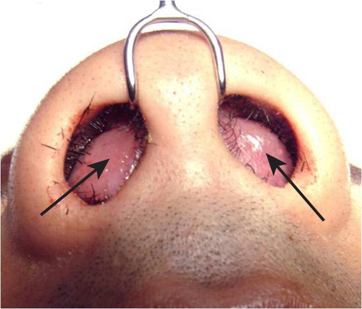 #CincyAI If a patient has any signs of new nasal fracture on exam or imaging, don’t forget to look for nasal septal hematoma! If present &amp; not drained, infection can develop within 3 days and ultimately cartilage necrosis leads to structural collapse