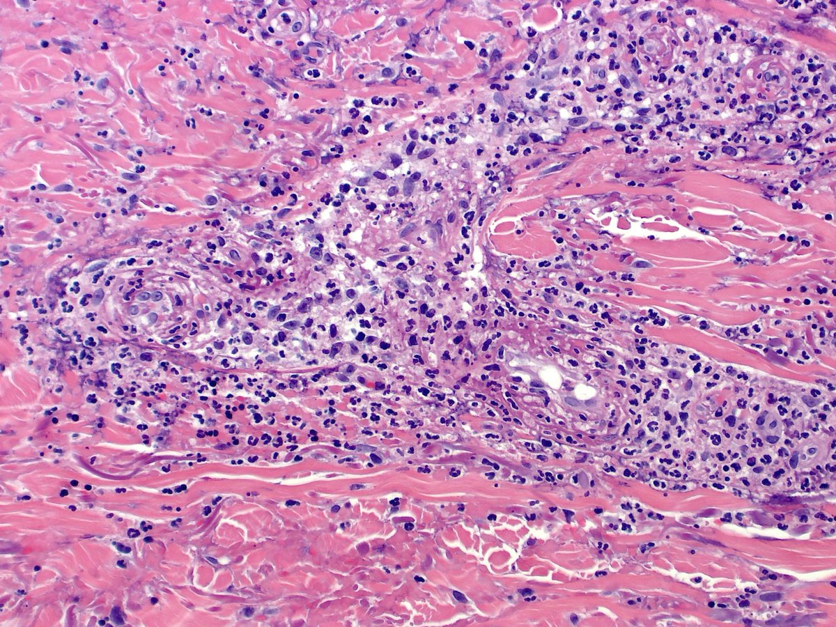 Papillary dermal microabscesses.  Is it dermatitis herpetiformis? No, it is IgA LCV.  In addition to the usual neutrophil rich subepidermal vesicular DDx papillary dermal microabscesses can occur in LCV, infections and other oddball things #dermpath #pathology #dermatology