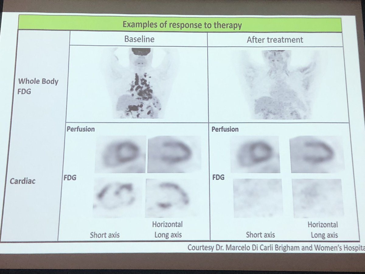 acepuba's tweet photo. PET-18 GDG utilidad en endocarditis+tumores cardiacos+ inflamación + procesos infiltrativos = múltiples utilidades @DraRosales77 @becerril_valdes @CardioPaty @ARCALorg @ctinocomesquita @RiquemexMN @IniciativaPCM @ANCAM_MEXICO @MujerSIAC @siacprevent @SIAC_cardio https://t.co/kGKKhhjmKa