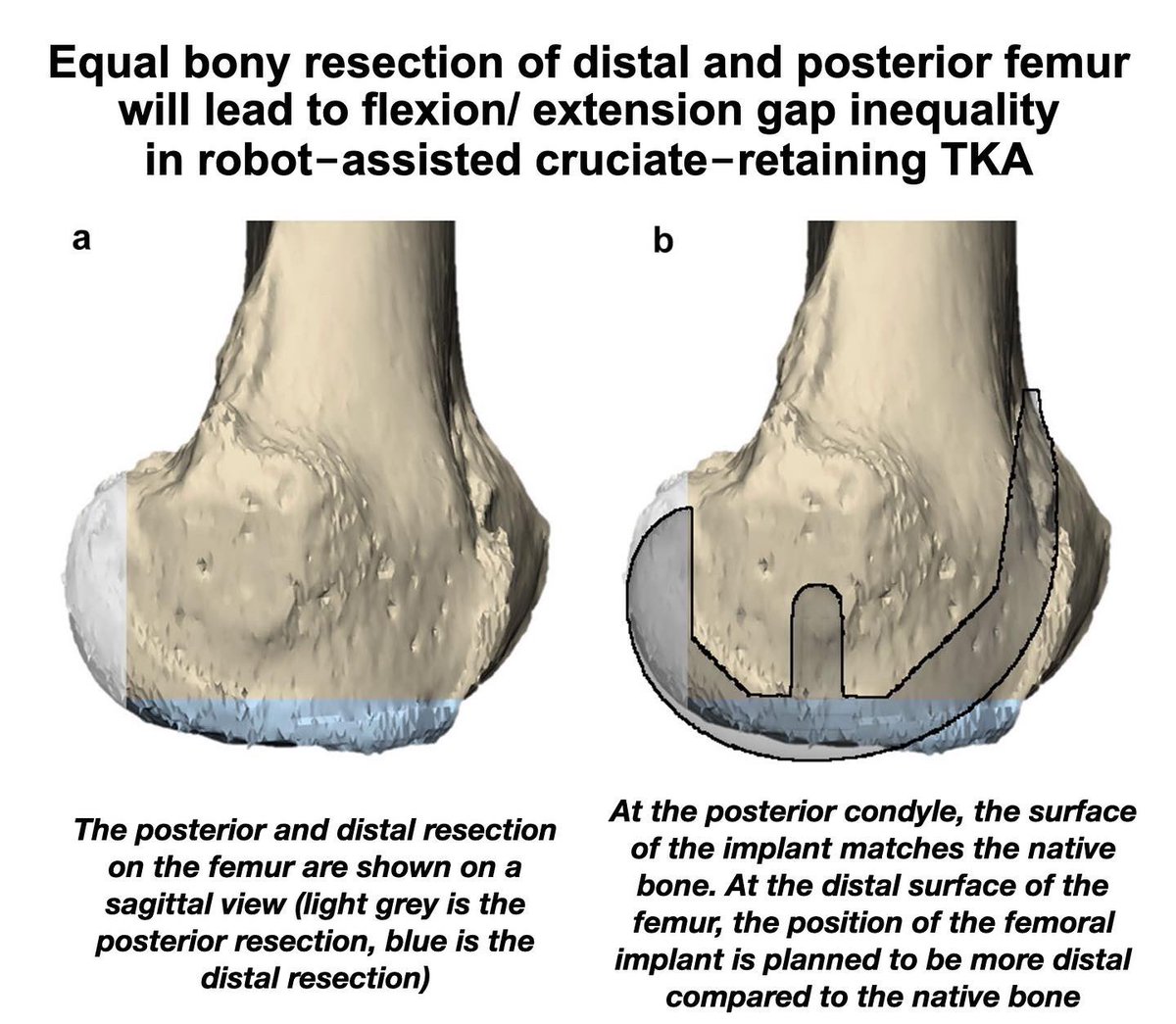KSSTA's tweet photo. In this robot-assisted TKA study, it was necessary to remove 1.5 to 2 mm more bone from the posterior condyle compared to the distal condyle in order to balance flexion/extension gaps

#kneereplacement

Link: https://t.co/3cpjL8nPpV https://t.co/rUl0RT7YSP