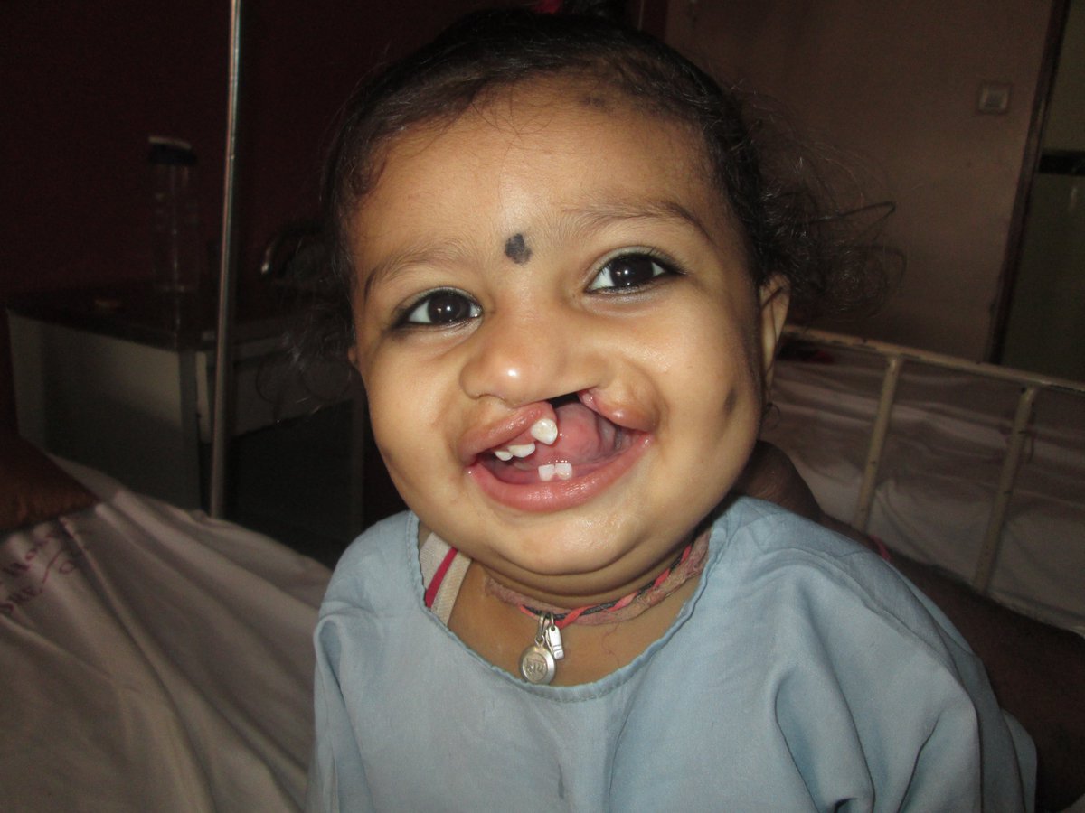 SmileTrainIndia's tweet photo. #InspiringFriday
Gopal is one of those lucky kids who ended up meeting @Smiletrain at the right age. A corrected smile is all that he needed and we were able to create it with the help of our partner surgeons.
Early treatment matters!
#CleftProud #CleftWarrior https://t.co/JmoQGGkajh