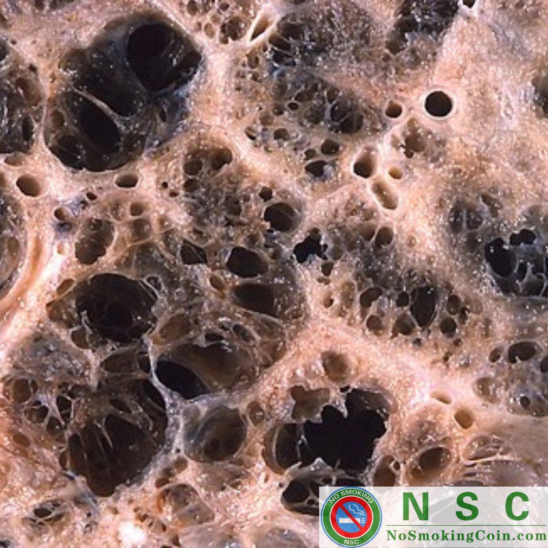 (COPD) is a type of progressive lung disease characterized by long-term respiratory symptoms and airflow limitation. The main symptoms include shortness of breath and a cough, which may or may not produce mucus.
#NSC #NoSmokingCoin #nosmoking