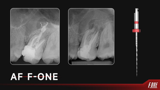 Mia75503607's tweet photo. Thanks to Dr. Emre Övsay for sharing his clinical case!
Fanta #AFFOne 13/03 for glidepath verification
20/04 Fanta AF F One for shaping
#15 NATRO File Recapitulation on MB
25/04 Fanta AF F One Blue for final finisher file for anatomical shaping.
#Fantadental https://t.co/LecauQ4aIF