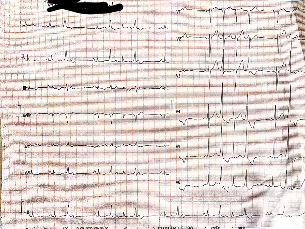 OP ECG -56 yr male , not known case of CAD ,no other co morbidities . H/O of syncopal attacks . Management ? #OPDecg @syamkumarmd @Tyr_simarak @UlhasDr